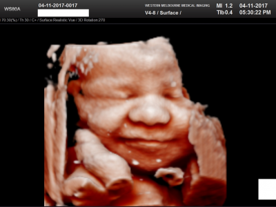 Early Gender Scan 孕妇早期性别扫描 ...